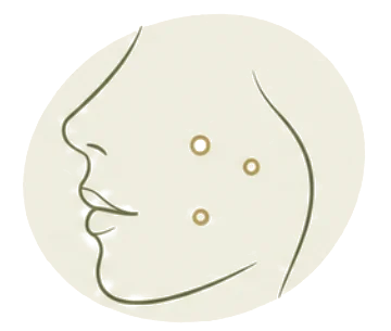 Illustratie acne: gezicht in profiel met puistjes op de wang