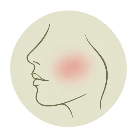 Illustratie roodheid en rosacea: vrouwengezicht in profiel met een rode blos op de wang, zoals bij een huid die snel rood wordt