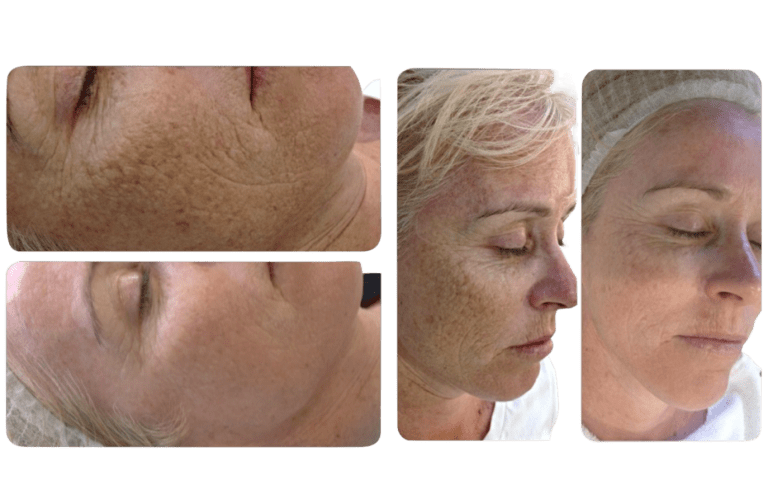dermapen behandeling